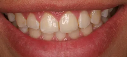 Before treatment at Queensway Dental