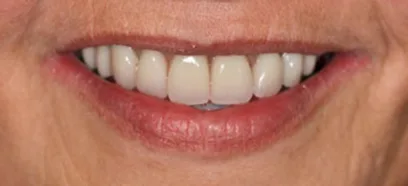 After treatment at Queensway Dental