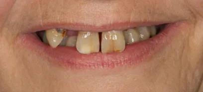 Before treatment at Queensway Dental