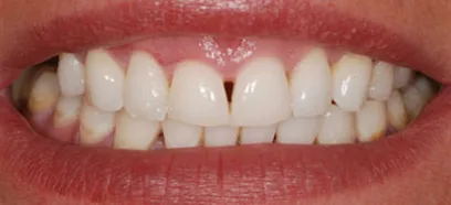 Before treatment at Queensway Dental