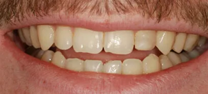 Before treatment at Queensway Dental