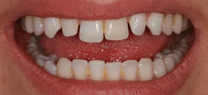 Before treatment at Queensway Dental