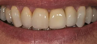 After treatment at Queensway Dental