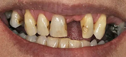 Before treatment at Queensway Dental