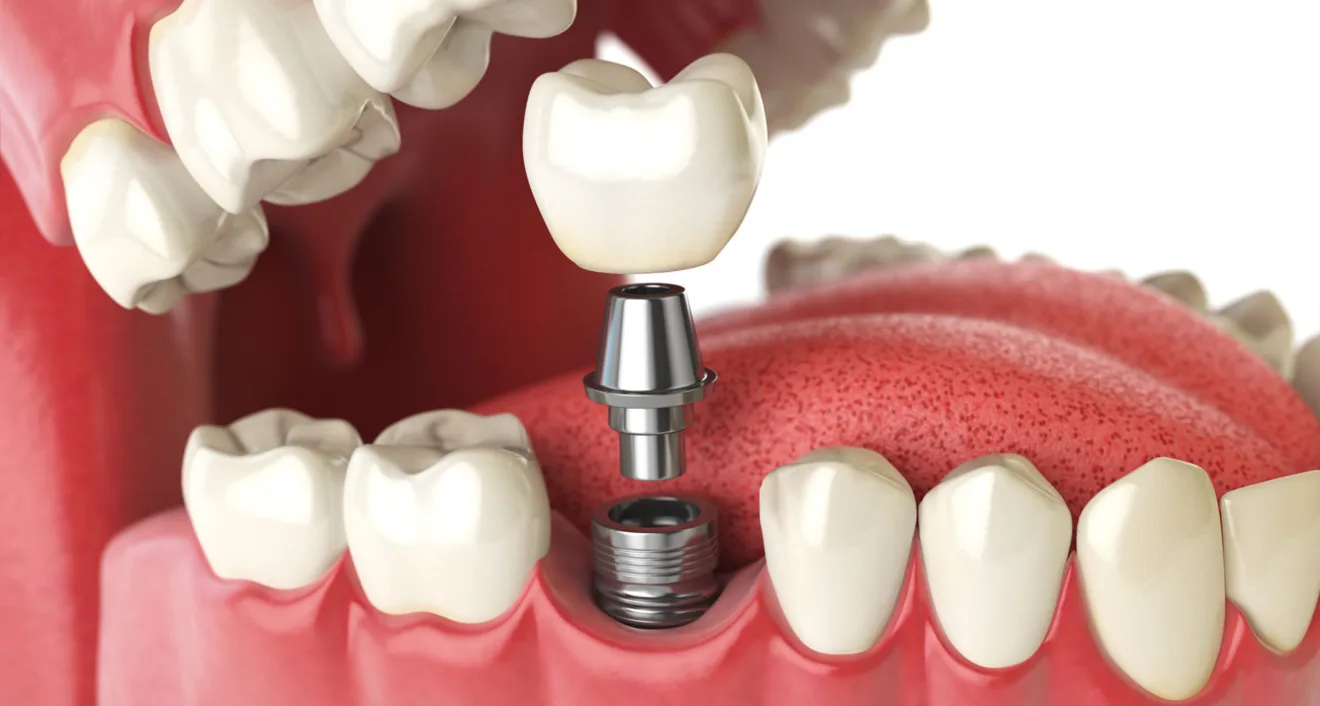 What To Expect From Modern Dental Implants: Your Complete Guide What To Expect From Modern Dental Implants: Your Complete Guide