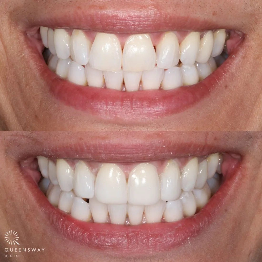 Natural-looking dental bridges crafted in the Queensway on-site lab Natural-looking dental bridges crafted in the Queensway on-site lab