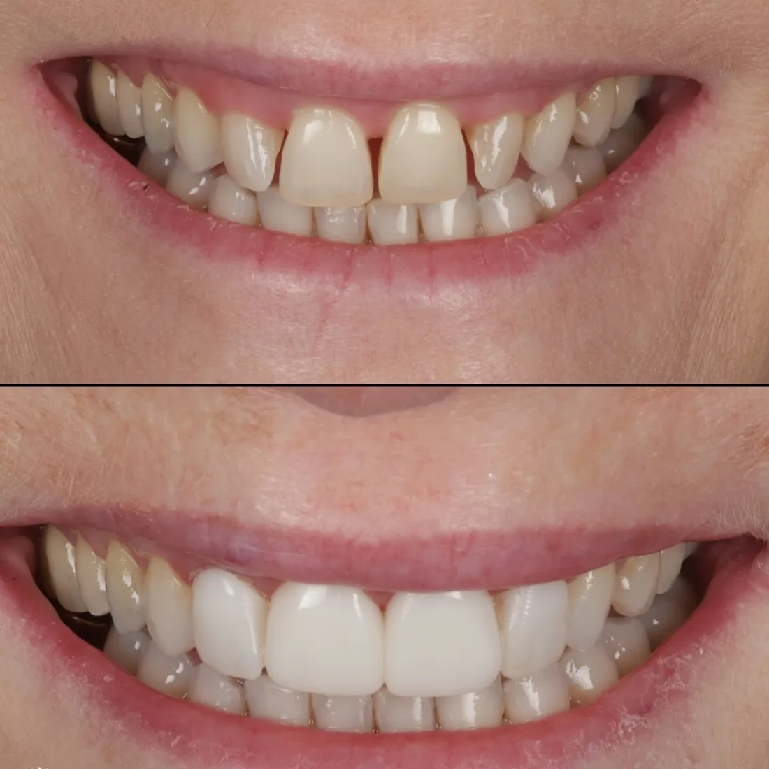 Long-lasting, natural-looking composite bonding result at Queensway Dental Long-lasting, natural-looking composite bonding result at Queensway Dental