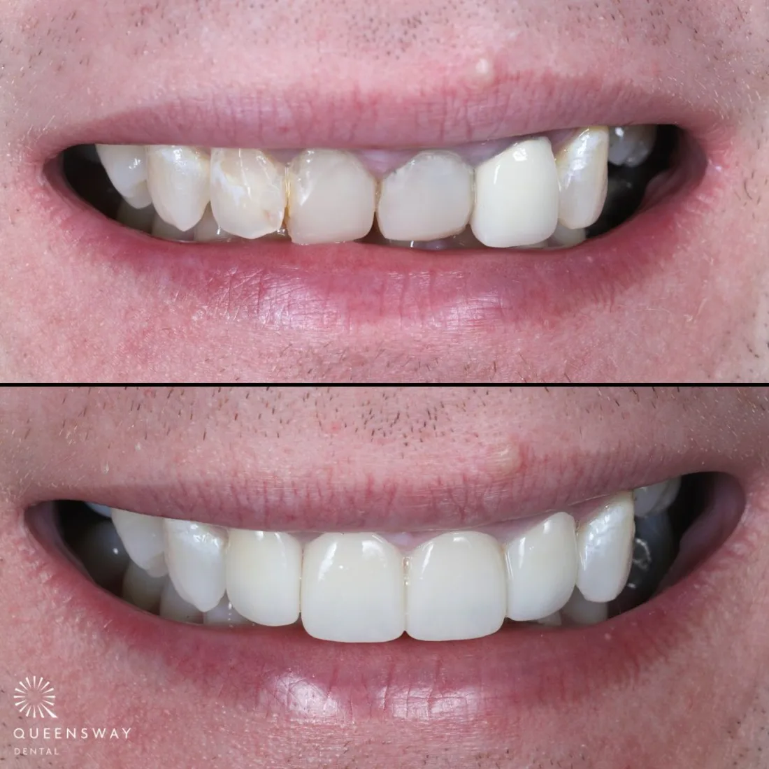 A natural-looking smile restored with dental crowns at Queensway Dental A natural-looking smile restored with dental crowns at Queensway Dental