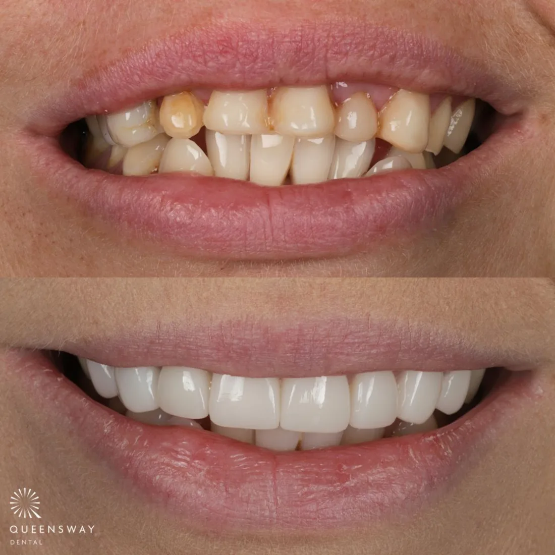 A restored smile with crowns and gum reshaping at Queensway Dental A restored smile with crowns and gum reshaping at Queensway Dental