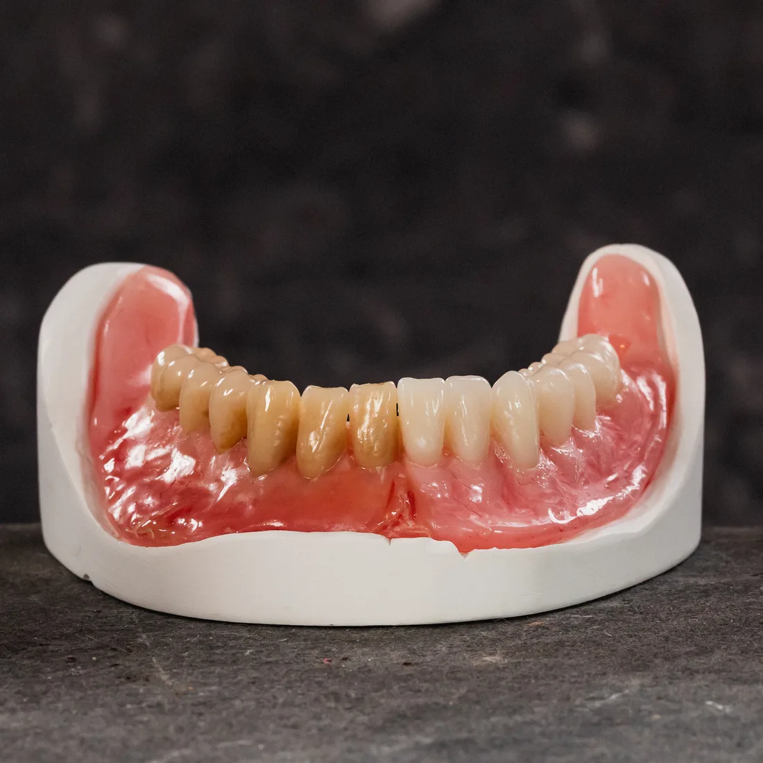 Partial, full and implant-supported dentures made at Queensway Dental