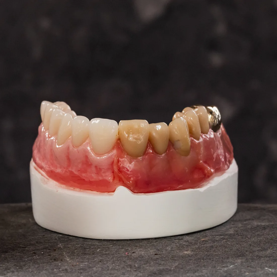 A set of custom-made dentures crafted in the Queensway on-site lab