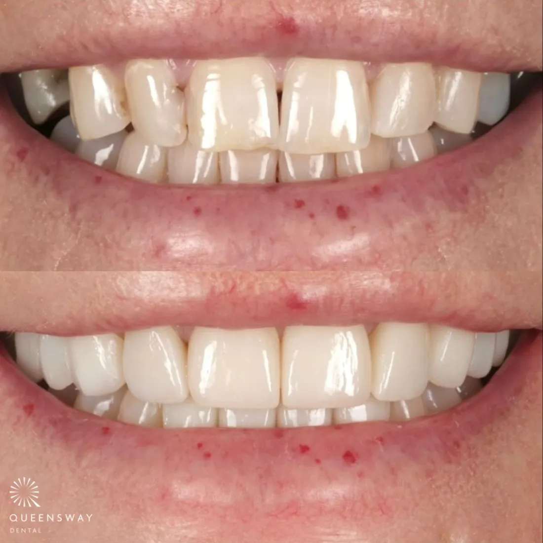 Close-up of an even, natural-looking tooth colour at Queensway Dental