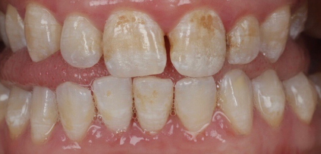 Before ICON treatment
