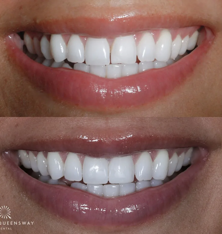 Composite bonding to repair a chipped tooth at Queensway Dental