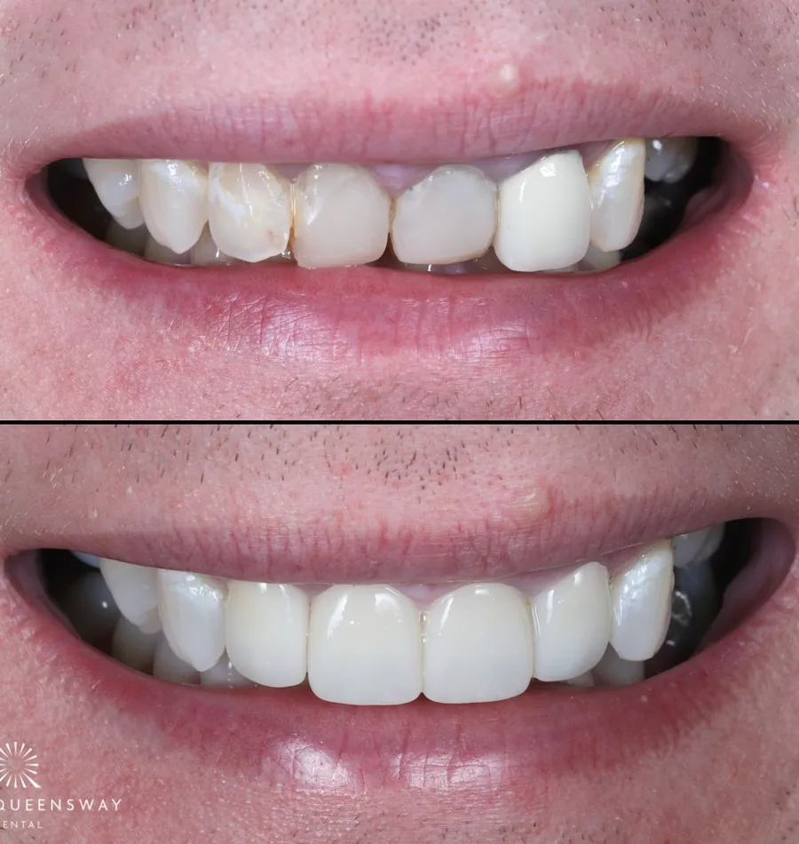 Ceramic dental crown at Queensway Dental