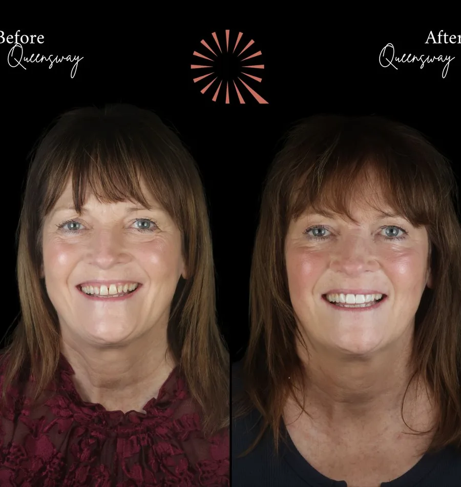 ICON white-spot treatment at Queensway Dental