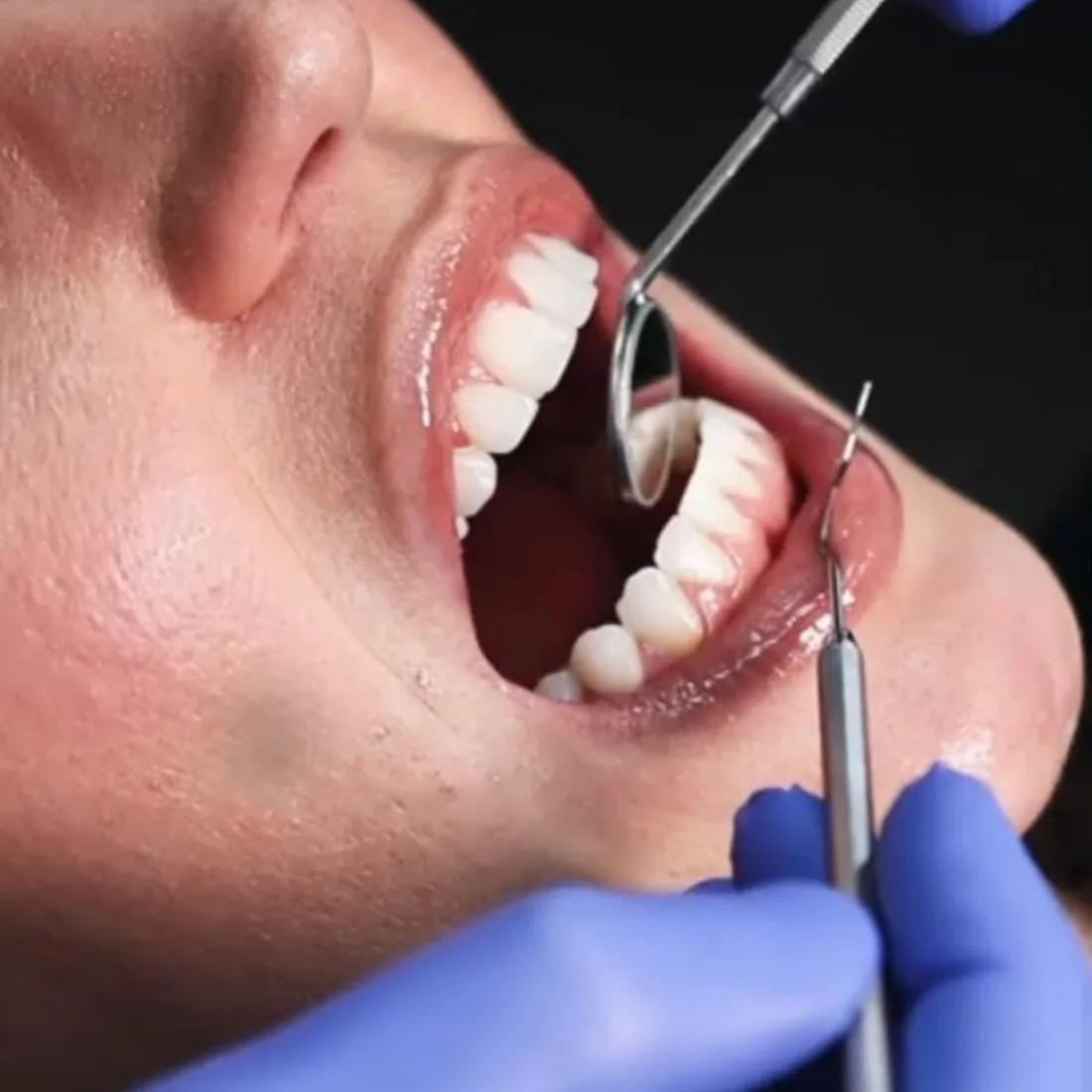 Close-up of a patient's tooth being examined at Queensway Dental Close-up of a patient's tooth being examined at Queensway Dental