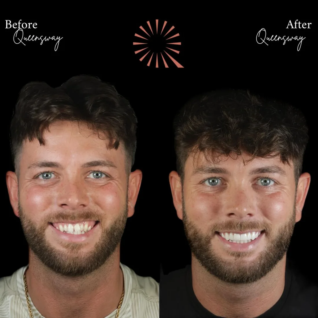 A patient's before and after smile transformation at Queensway Dental A patient's before and after smile transformation at Queensway Dental