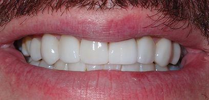 The patient's finished smile after treatment The patient's finished smile after treatment