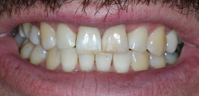 Patient's smile before Trial Smile treatment Patient's smile before Trial Smile treatment