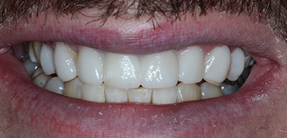 The same patient wearing their Trial Smile The same patient wearing their Trial Smile
